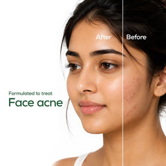 AcneGuard Face wash Gel